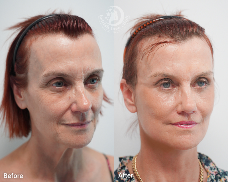Deep Plane Facelift Before and After