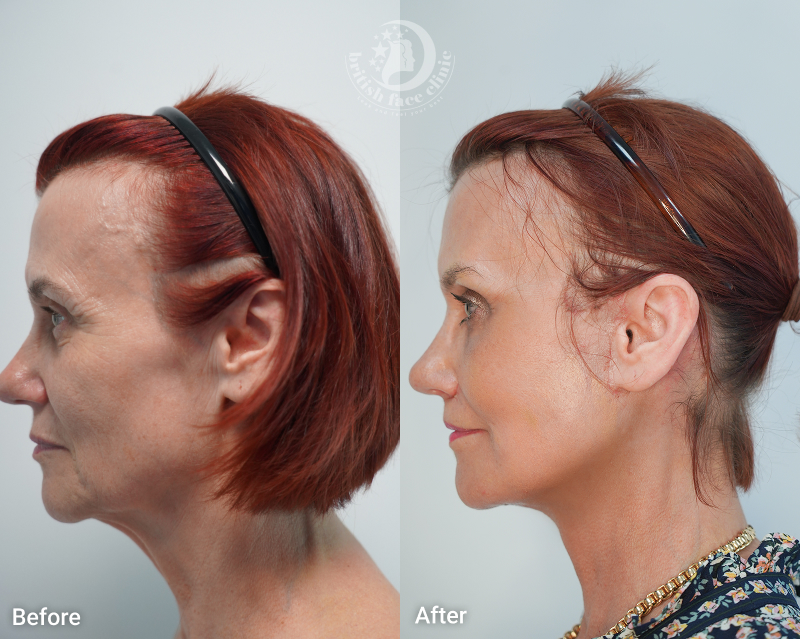 Deep Plane Facelift Before and After
