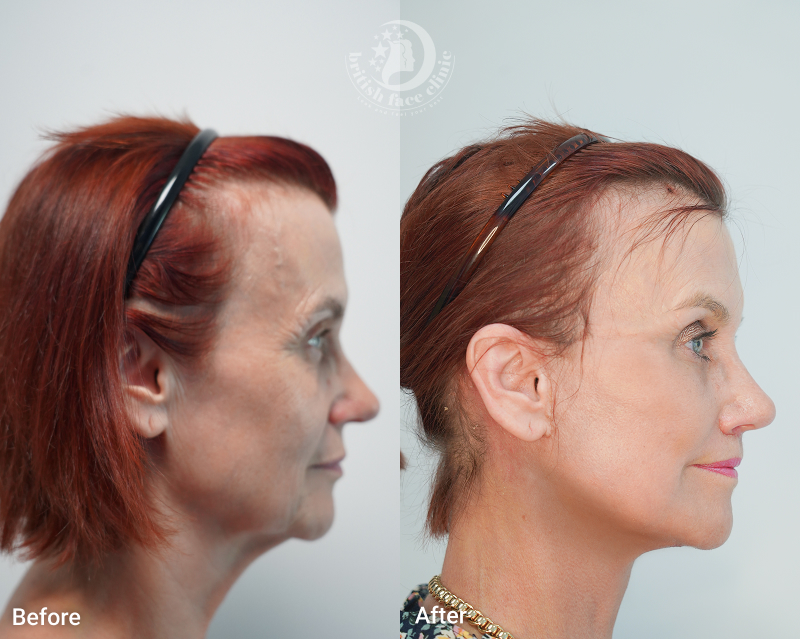 Deep Plane Facelift Before and After